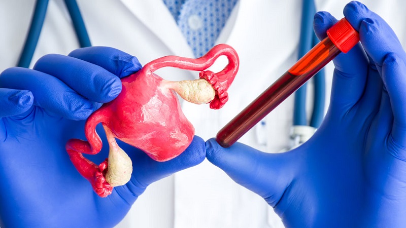 পিসিওএসে আক্রান্ত ১০ নারীর একজন 